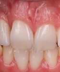 Castro_after_gingiva