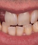 Castro_before_vm9 gingiva