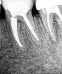before_periapical