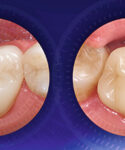 vitablocs-kronen-440×230